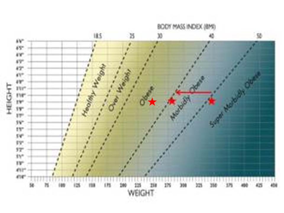 Morbid Obesity Chart Height Weight